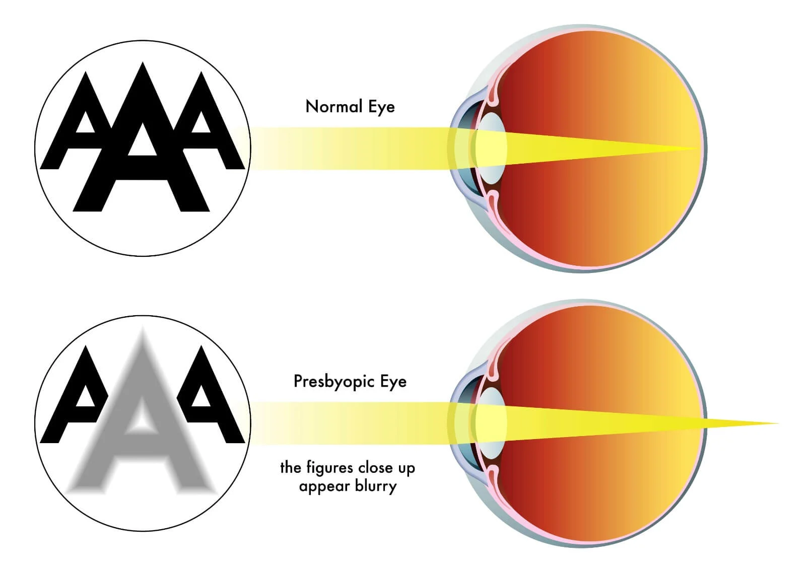 Presbyopia-11