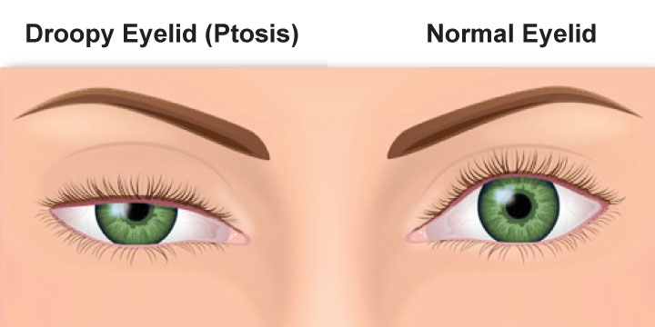ptosis-causes-symptoms-treatments