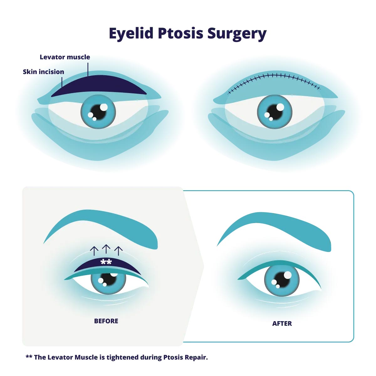 ptosis-surgery-min
